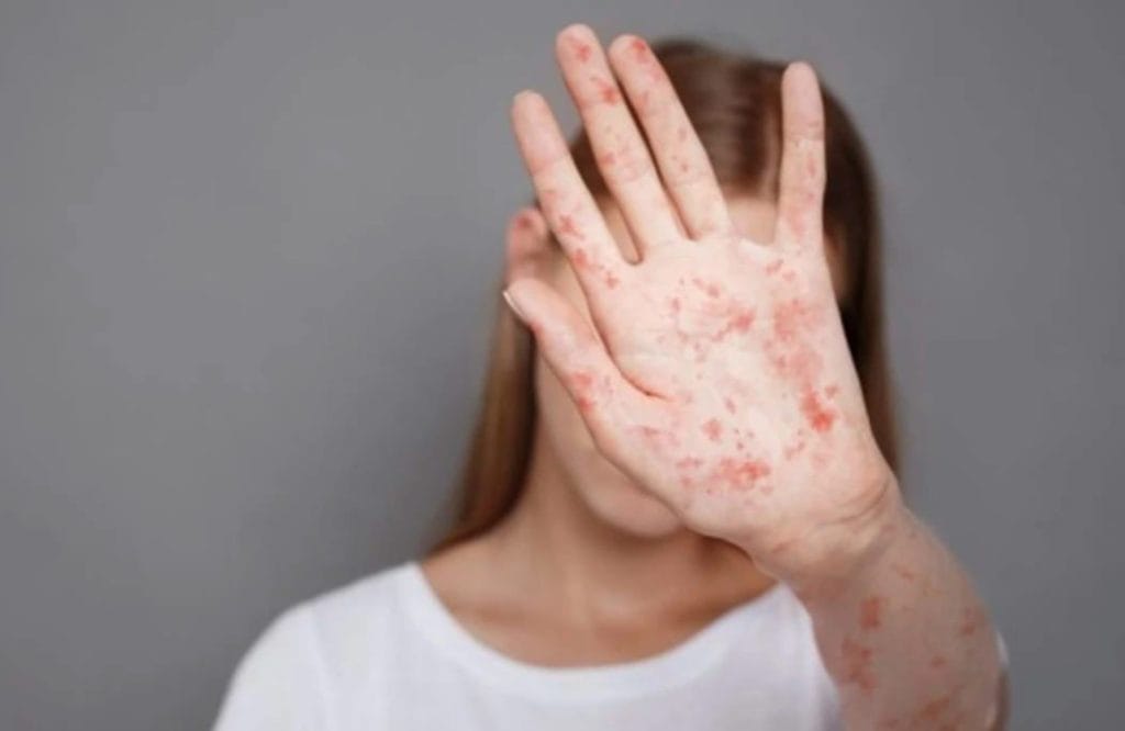 تفشي الحصبة في العرائش يثير القلق ويدفع وزارة الصحة للتحرك