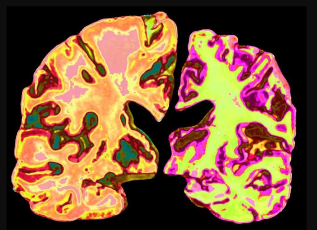 Percée scientifique : le faible taux de lithium pourrait être la clé de la compréhension et du traitement de la maladie d’Alzheimer دراسة: انخفاض الليثيوم في الدماغ قد يساهم في تطور الزهايمر