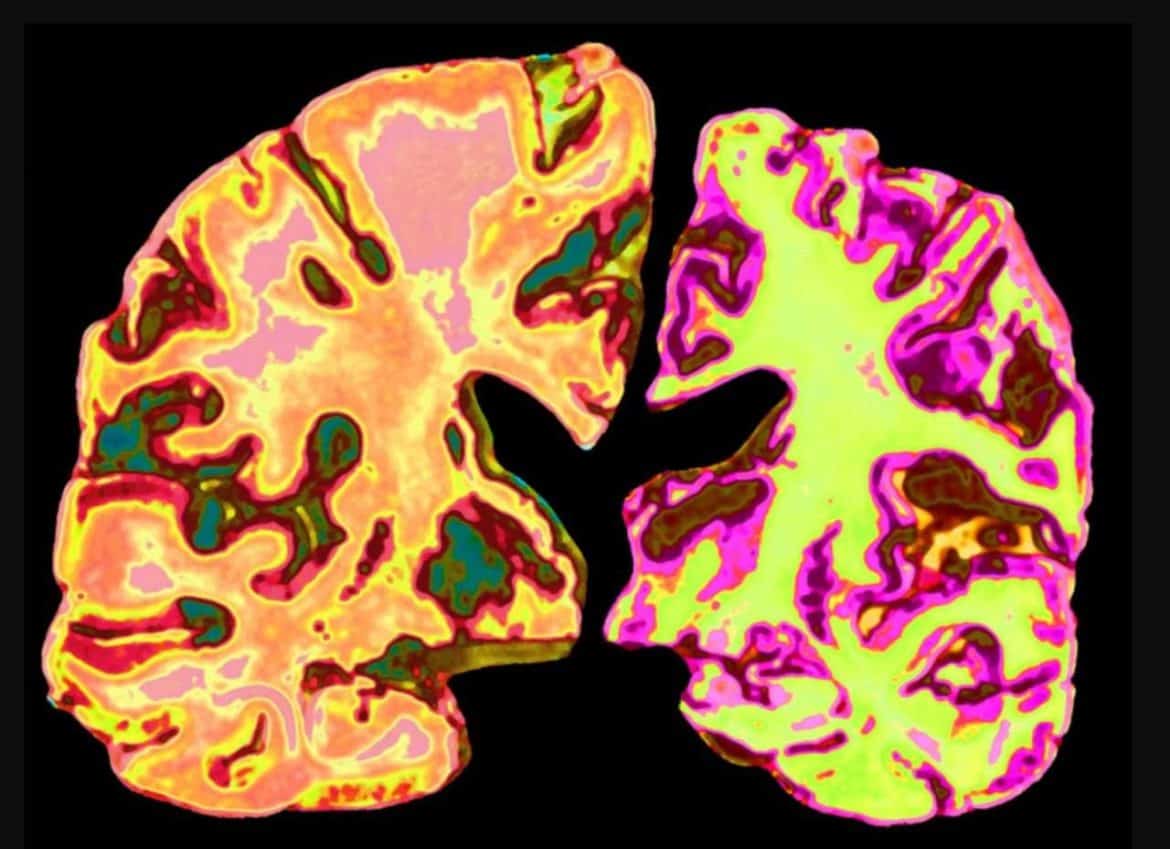 دراسة: انخفاض الليثيوم في الدماغ قد يساهم في تطور الزهايمر